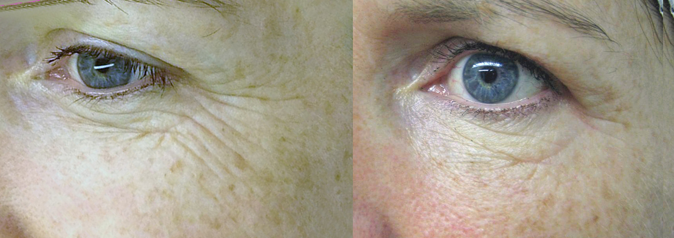 Before & after 3 INTRAcel Light for the eyes