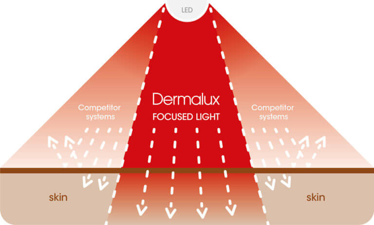 DERMALUX-New-Focused-Light-Diagram