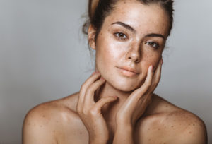 Acne Scar Treatment