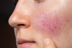Vascular Concerns