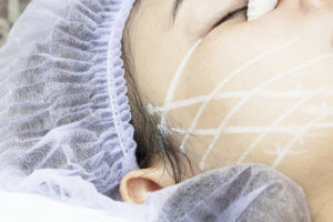 Silhouette Thread Lift