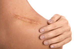 Body Scarring Treatment
