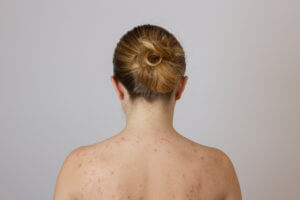 Body Acne Scar Removal