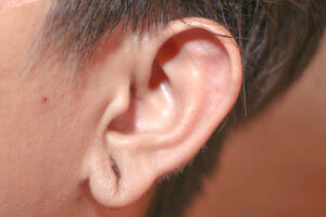 Torn Earlobe Repair