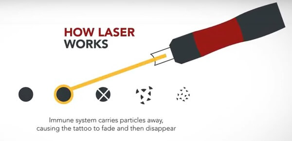 graphic of the laser removing tattoo