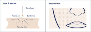 graphic of plasma pen device