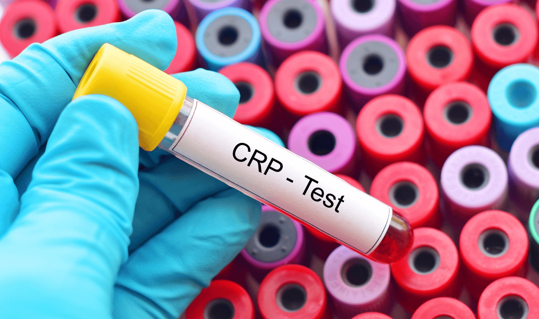 C Reactive Protein Test Private Blood Tests London