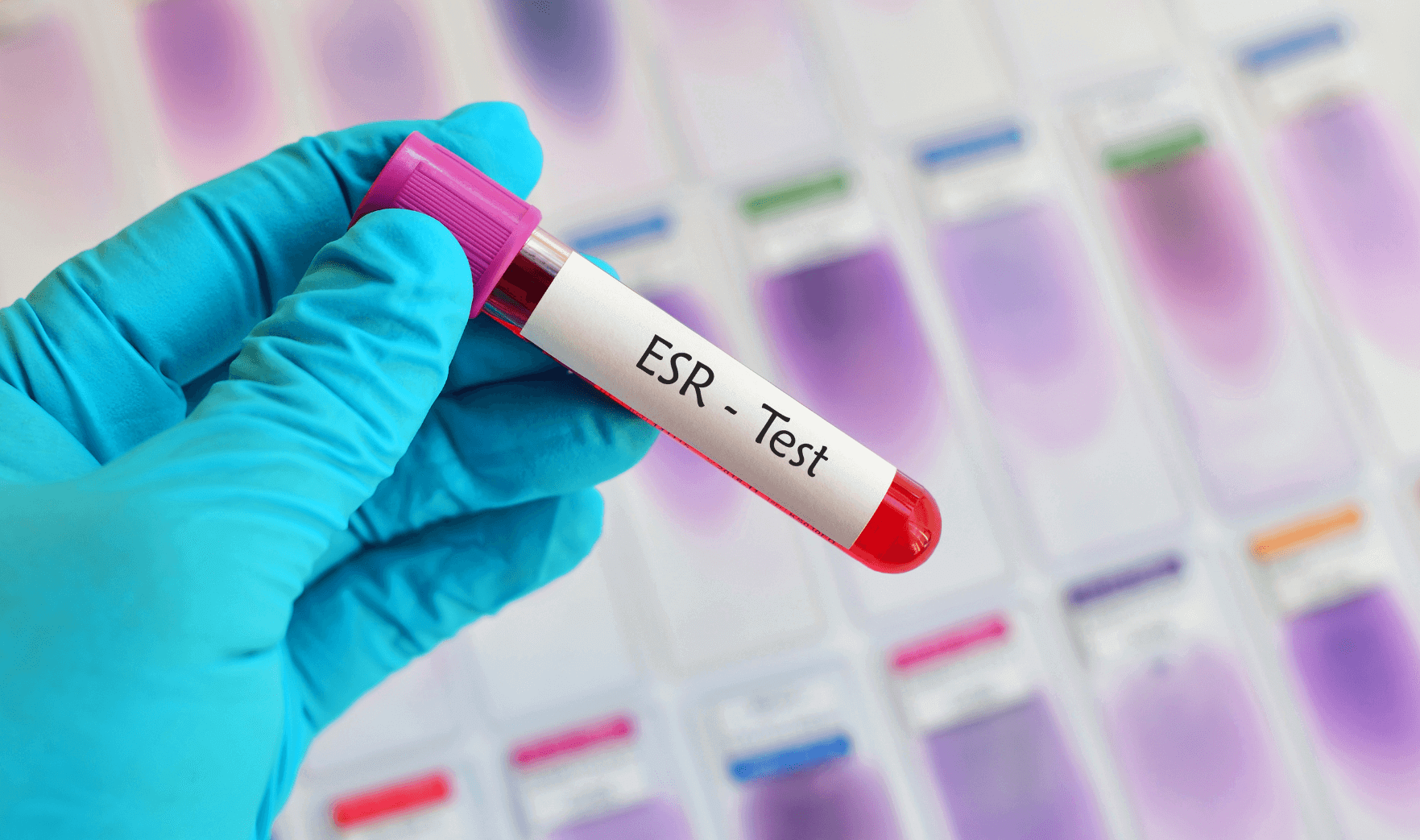 ESR Blood Test - Private Blood Testing