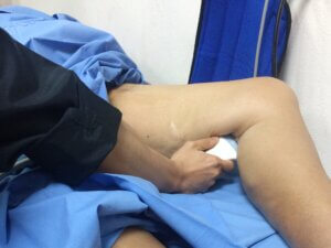 Deep Vein Thrombosis