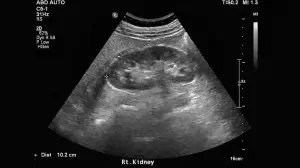 Ultrasound of kidney renal