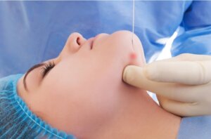 Endolift Laser Treatment