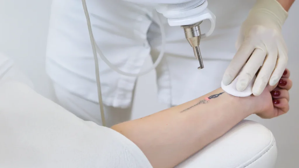 Laser Tattoo Removal