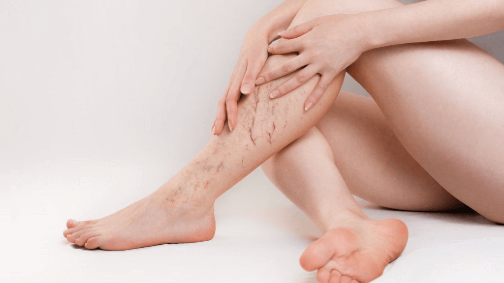 Ways To Minimise Spider Veins On Legs